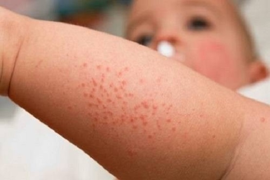 Dấu hiệu bệnh sốt phát ban ở trẻ em 1