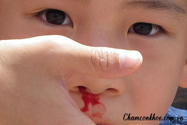 Hình ảnh sốt xuất huyết ở trẻ em 6
